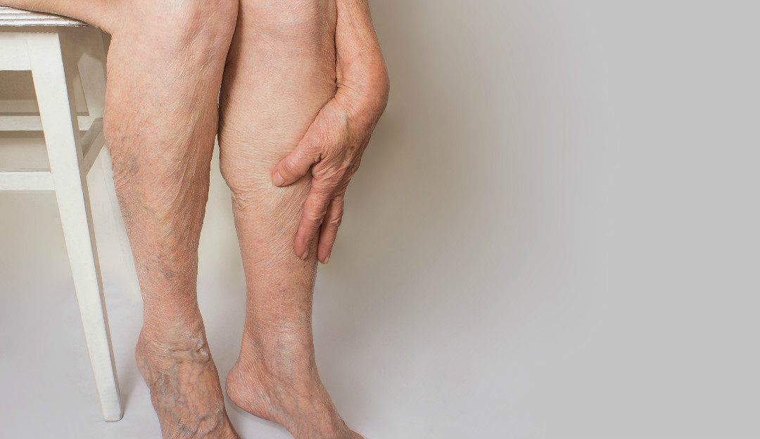 Varicose Veins: What Causes It and How Can You Treat It?