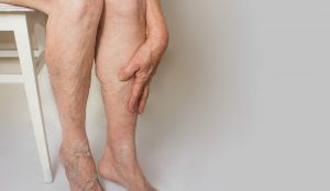 varicose veins